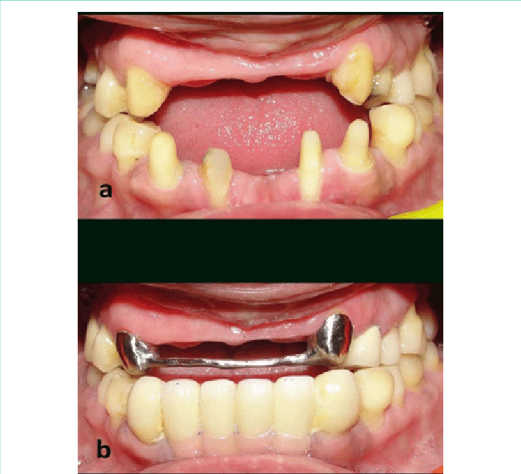 Pre Rehabilitation View And (b) Intraoral View Post (744x676), Png Download