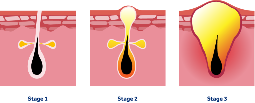 Different Grades Of Acne (1024x415), Png Download