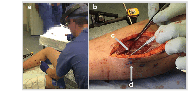 A Case 5 Marking Of Skin Under Hololens Guidance (850x374), Png Download