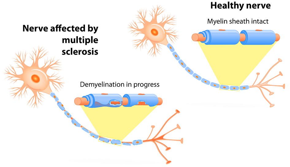 Multiple Sclerosis, Ms, Dubai (945x555), Png Download