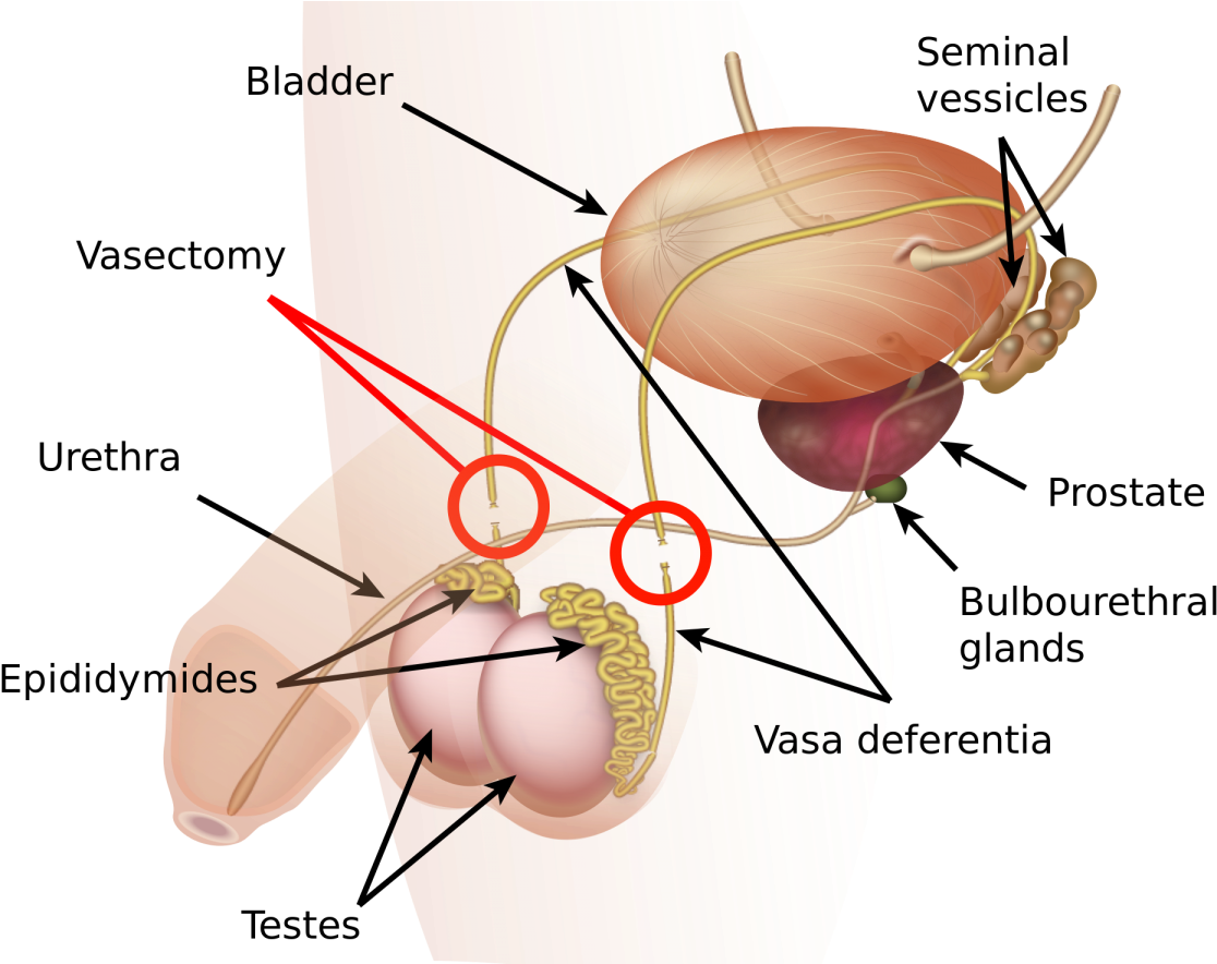 Male Sterilization (1200x883), Png Download