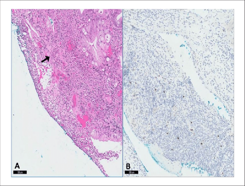 Biopsy Result Of Suspicious Gastric Mass Revealed Multiple (850x645), Png Download