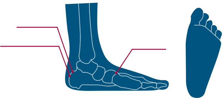 Types Of Flat Foot (924x385), Png Download