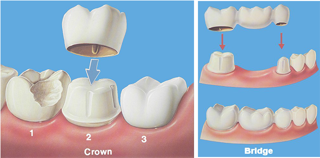 Crown-bridge (949x333), Png Download
