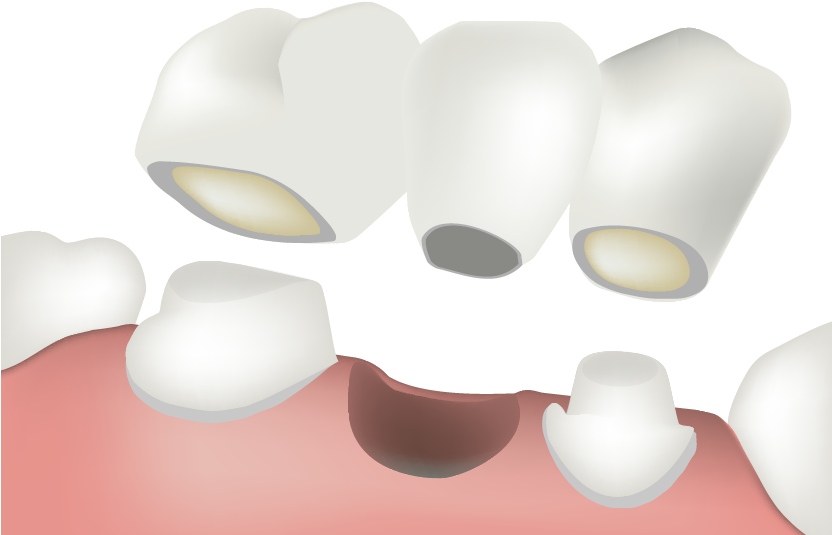 Porcelain Bridges (850x586), Png Download