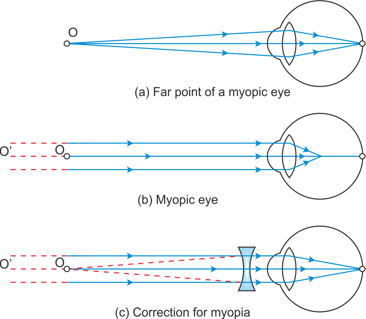 Hypermetropia Or Far Sightedness - Curvature Of The Eye Lens (747x651), Png Download