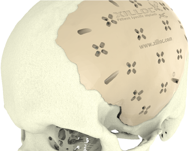 Cranial Implant - Implant (1000x500), Png Download