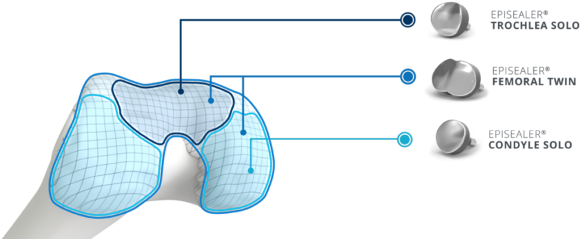 Episurf Medical Reaches Milestone Of 300 Implants - Diagram (880x395), Png Download