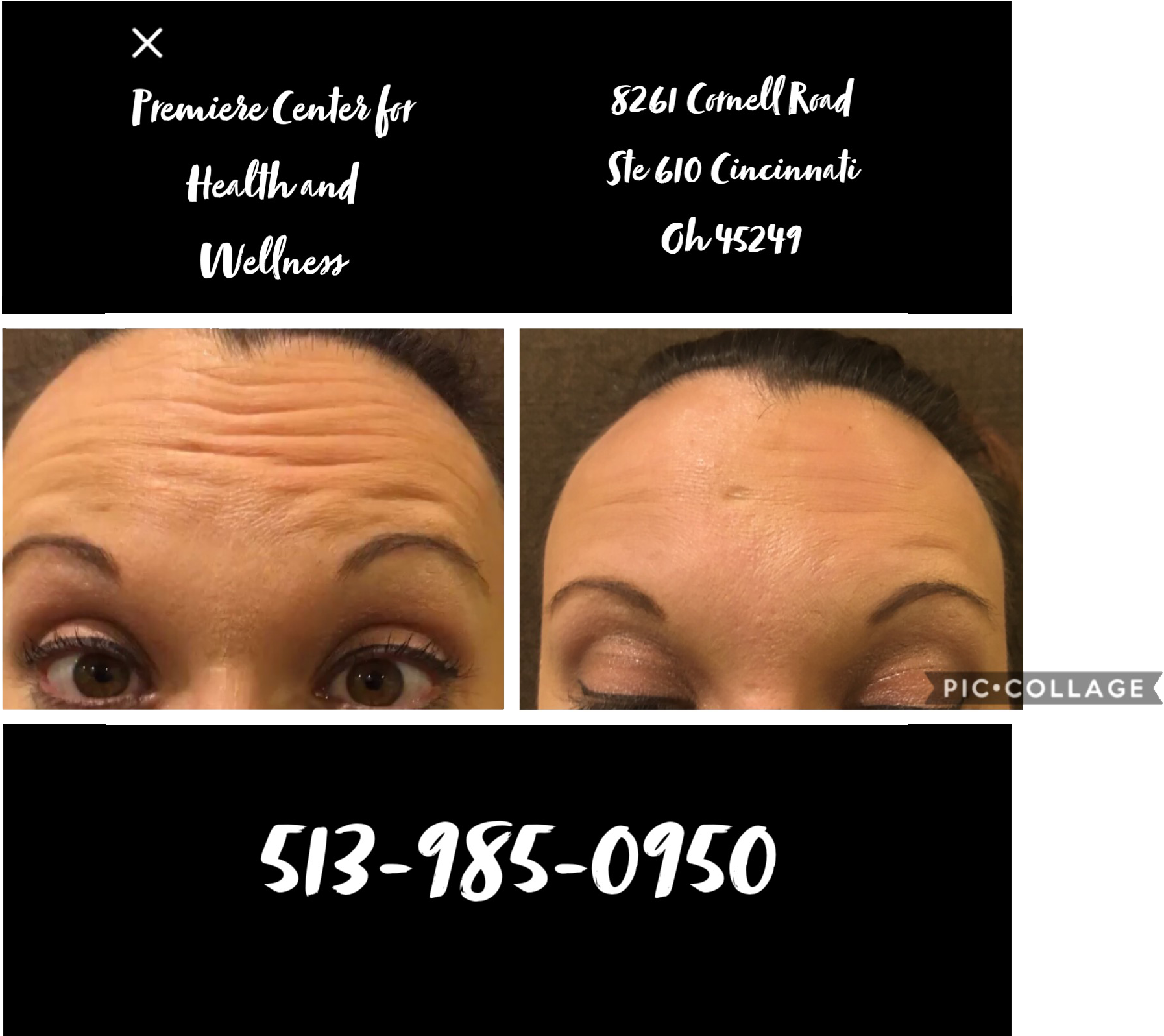 How Does Botox® Work (2400x1596), Png Download