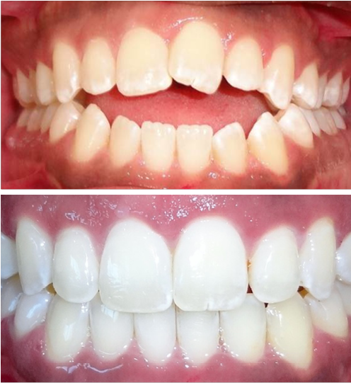 Invisalign Before And After - Dentures (495x636), Png Download