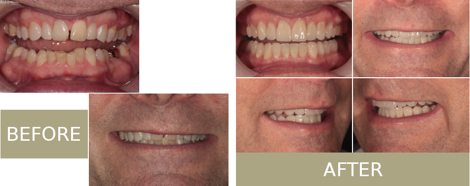 Jon Came To Us Upset With The Way His Smile Presented - Tongue (952x378), Png Download