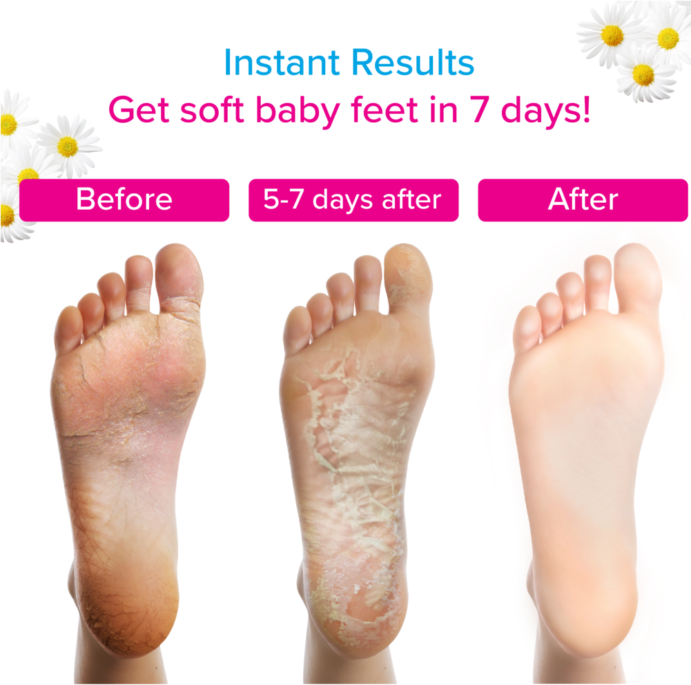 feet after foot peel