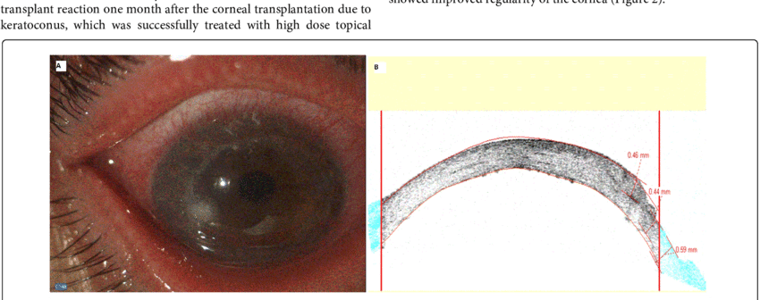 Fungal Keratitis In A Corneal Graft - Fungal Keratitis (850x336), Png Download