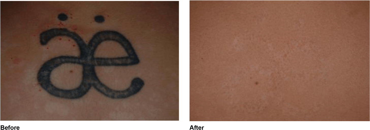 Tattoo Removal (1600x614), Png Download