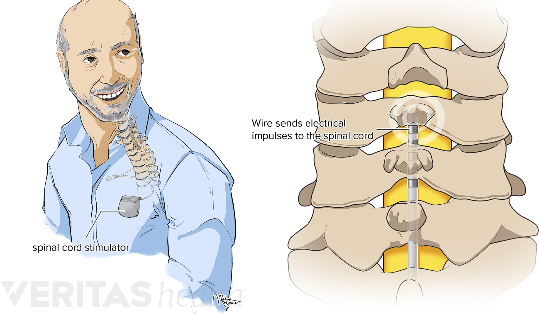 Spinal Cord Stimulators And Pain Pumps - Cartoon (1200x630), Png Download
