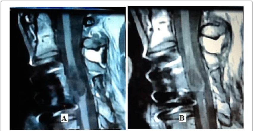 Tractographic Images Of Spinal Cord Of A Patient With - Visual Arts (850x441), Png Download