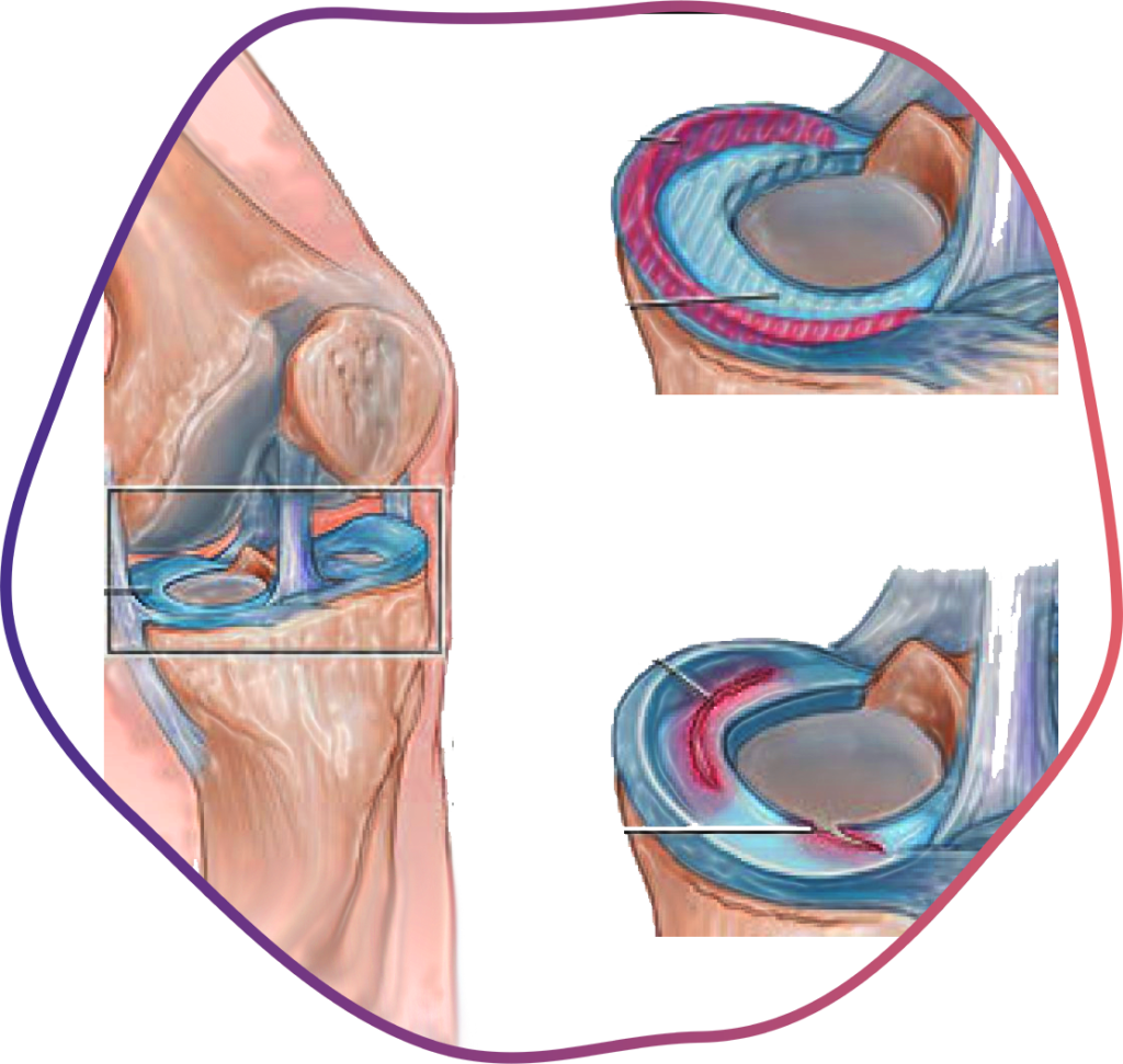 Ligament & Cartilage Tears - Illustration (1024x971), Png Download
