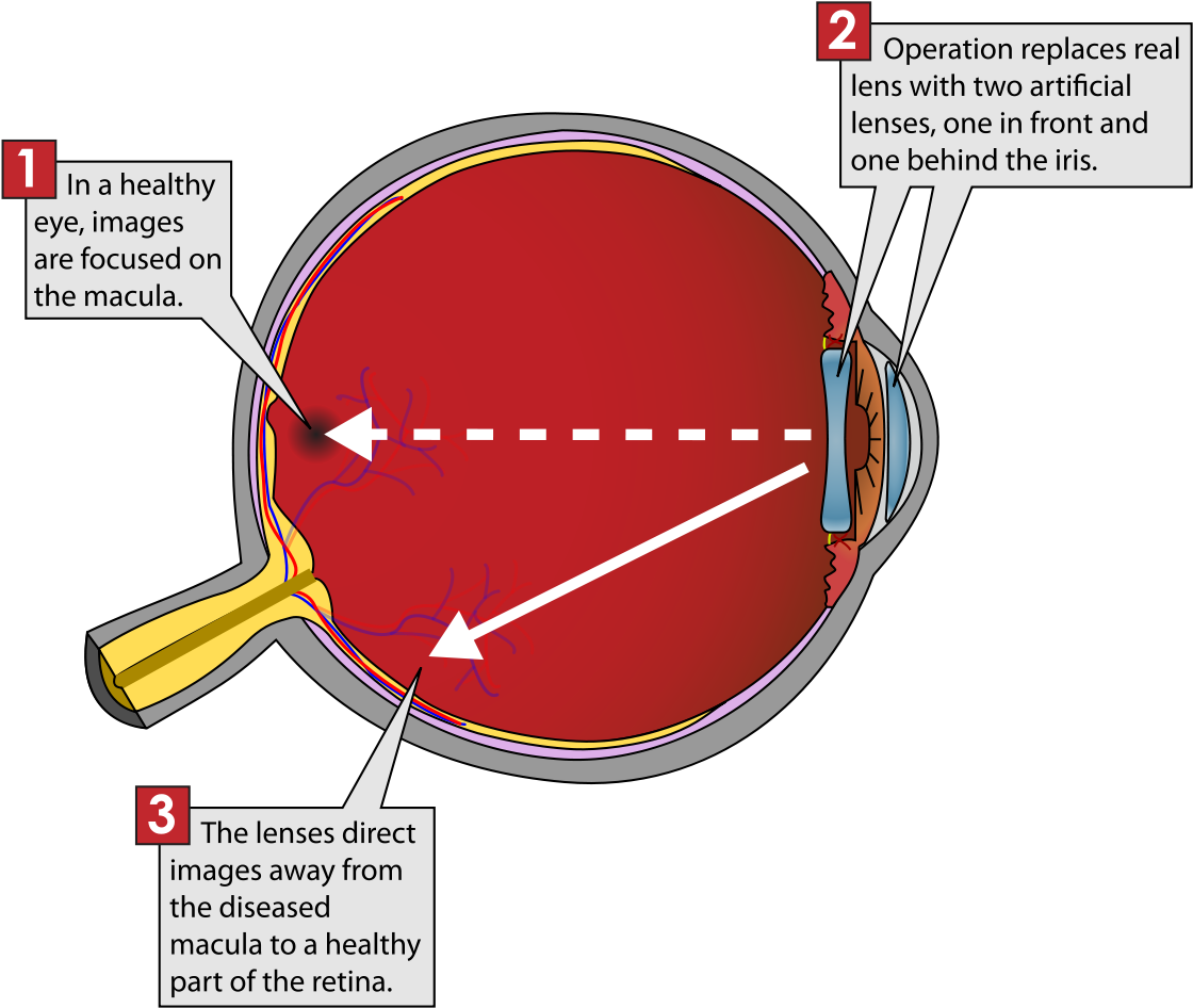 Iolvip - Implantable Miniature Telescope Diagram (1200x1022), Png Download