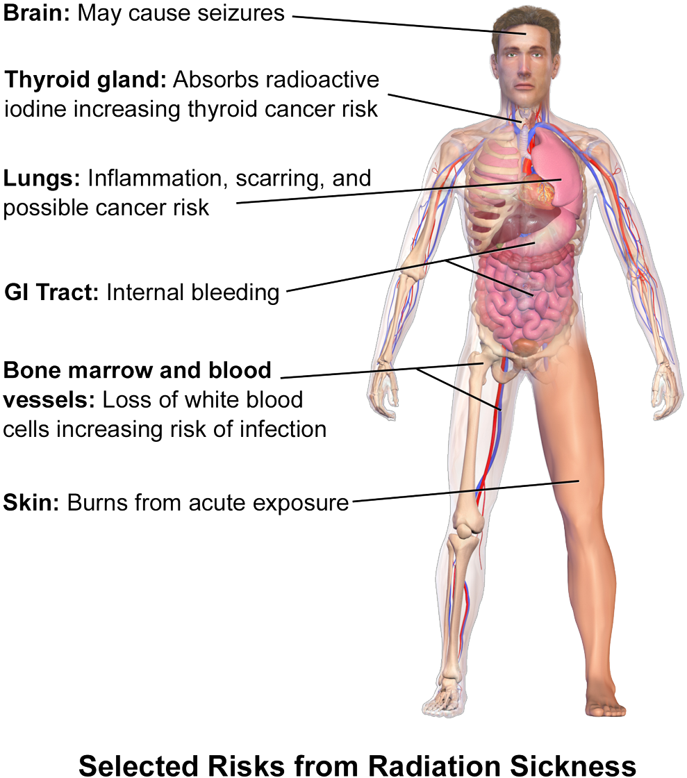 Radiation Sickness (1059x1200), Png Download