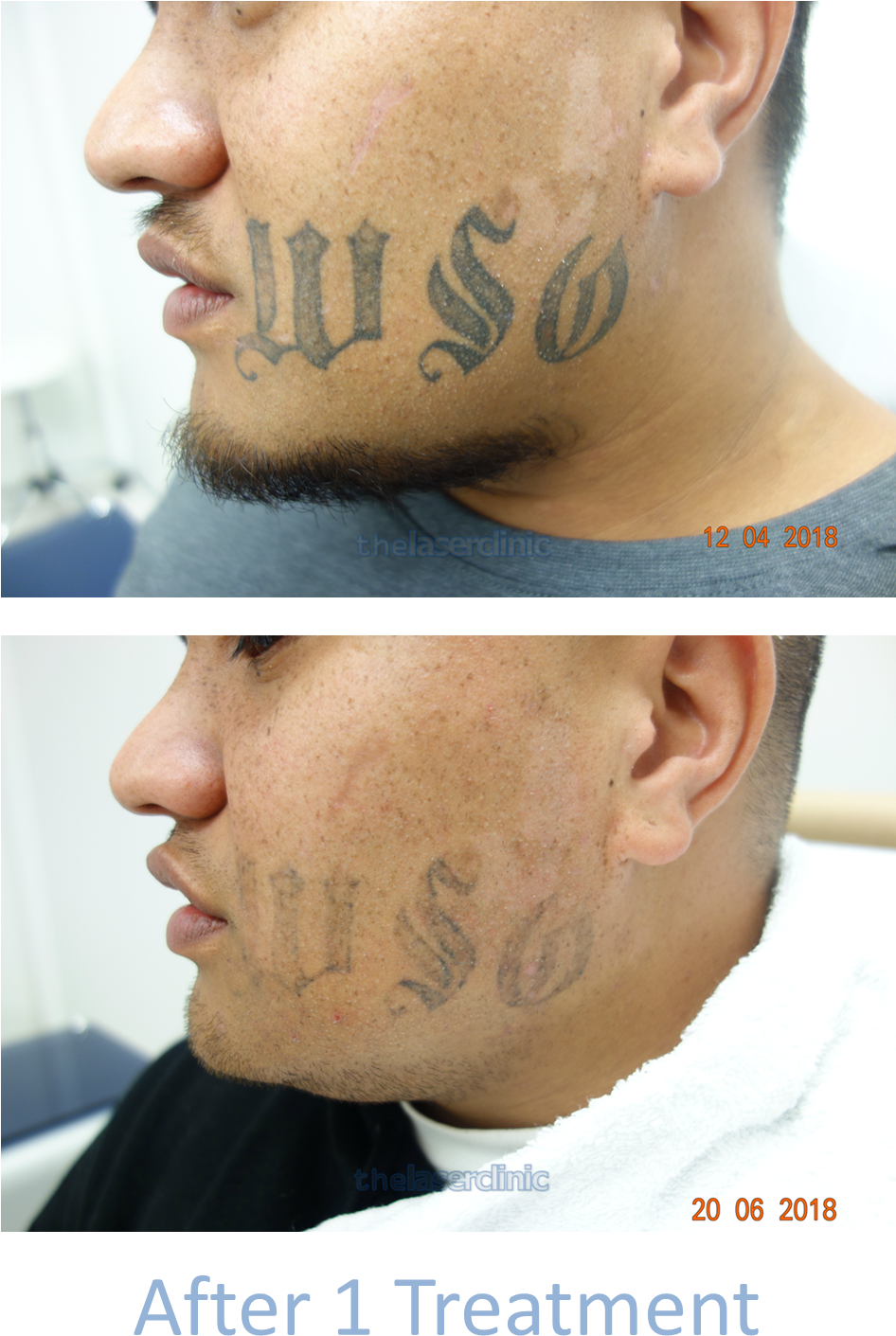 Facial Tattoo Removal - Poster (1012x1488), Png Download