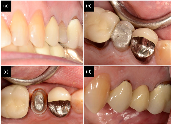 Patient Complained About The Second Premolar Tooth - Tongue (903x429), Png Download