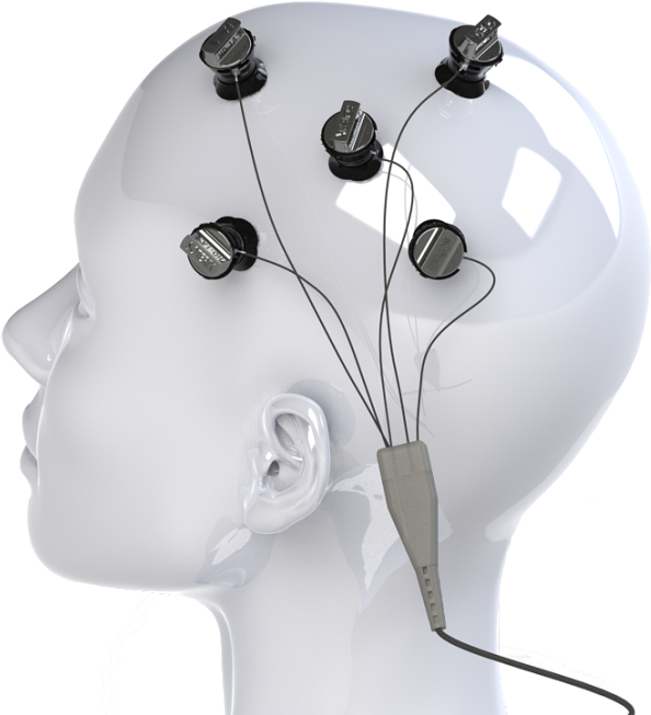 4x1m1 Hd Small - Multi Channel Tdcs (631x661), Png Download