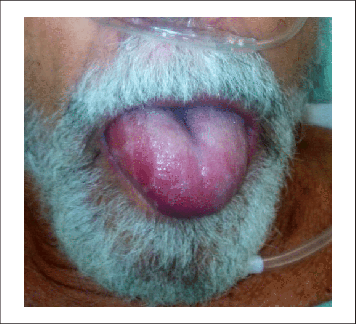 Rapidly Progressive Angioedema To The Tongue - Cat Yawns (708x645), Png Download