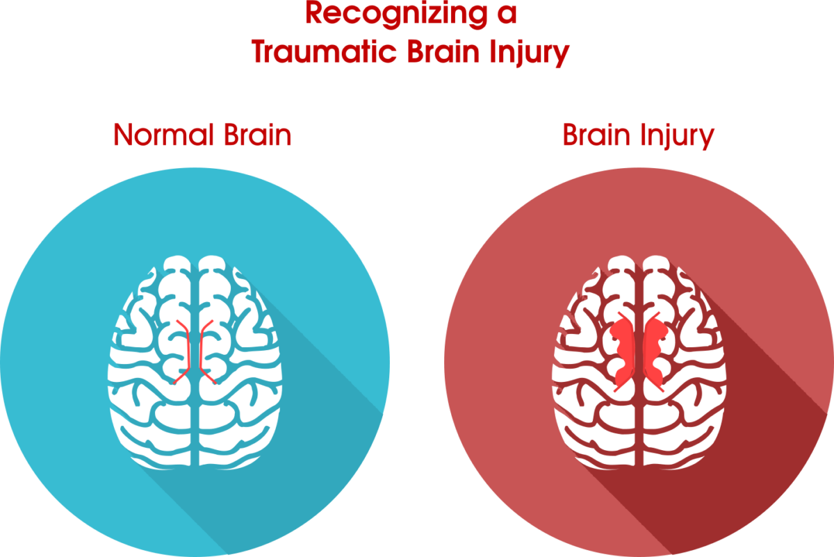 Imagine You've Got An Extremely Big And Elaborate Jigsaw - Normal Brain Vs Injured Brain (1200x802), Png Download