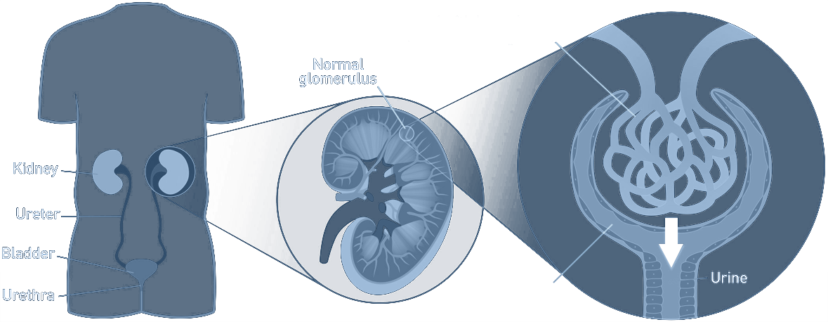 Fabry Disease Renal Symptoms Graphical Image - Illustration (1179x458), Png Download