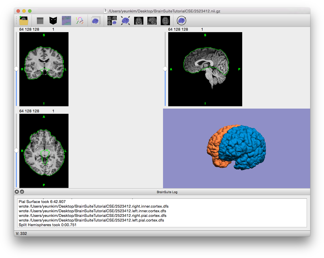 Final Output Of Cse, With Cross-hairs Off And Volume - Circle (1136x902), Png Download