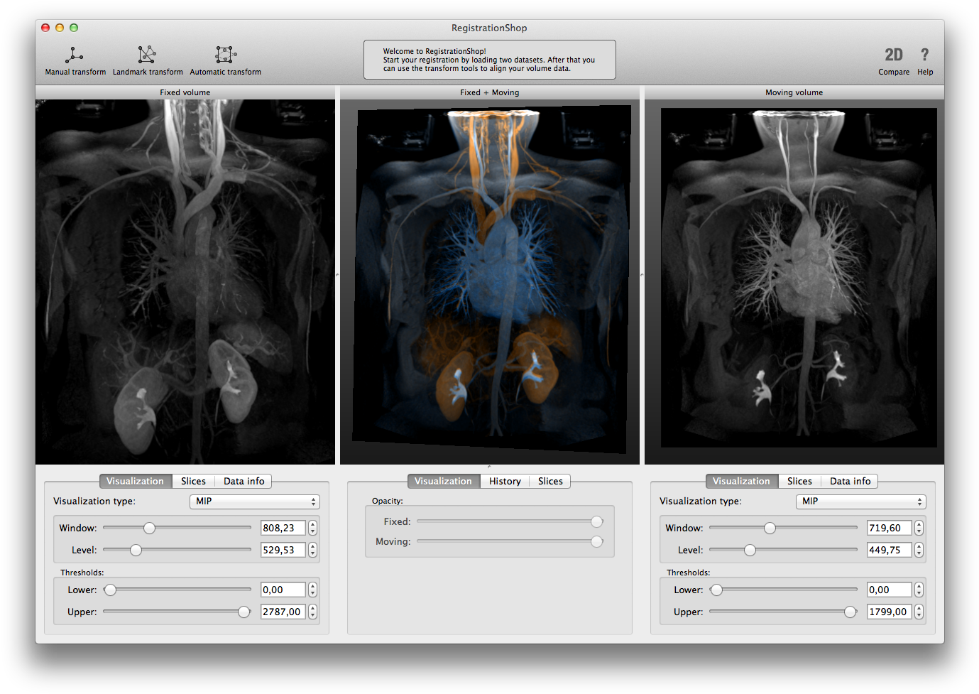 1003-10arterialvenousmip [795ko] - Computed Tomography (1394x992), Png Download