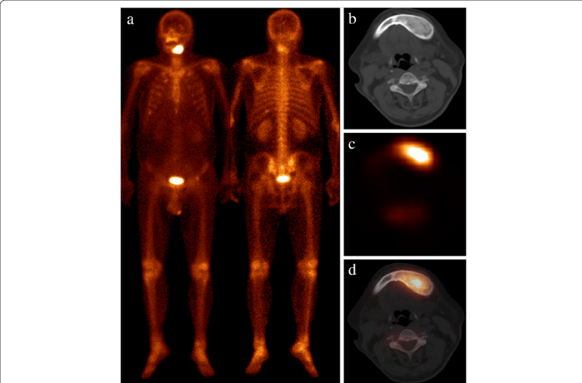 Patient 1 Presented With Newly Diagnosed Lung Cancer - Darkness (850x559), Png Download