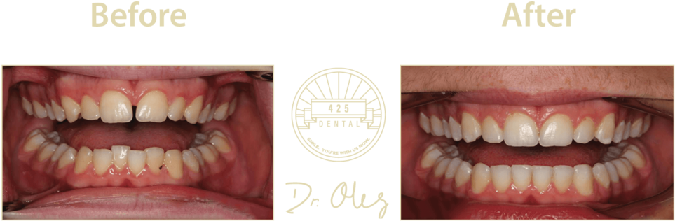 425 Before After Invisaline22 - Portable Network Graphics (1000x462), Png Download