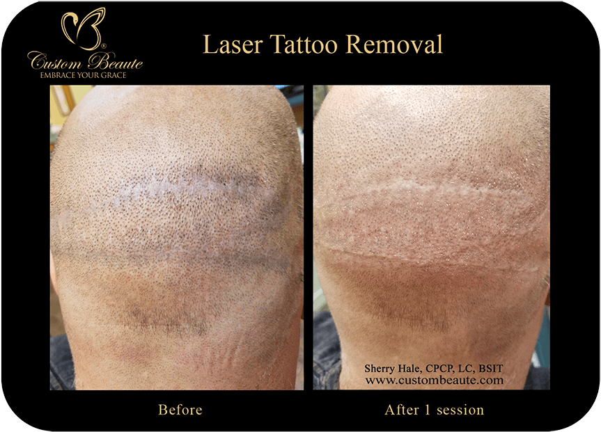 Video Player - Embrace Scar Before And After (1000x667), Png Download