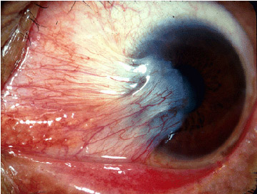 Eyes Pterygium - Ocular Rosacea Eye (1000x354), Png Download