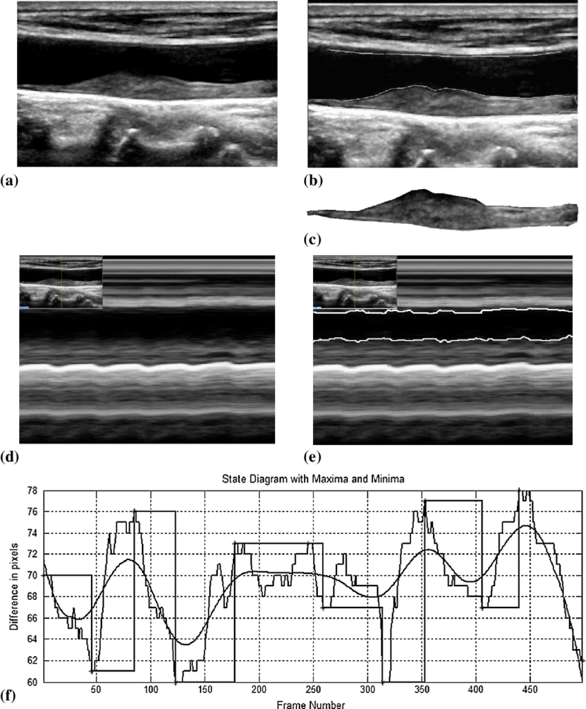 Illustration Of The M-mode Procedure - Monochrome (850x1028), Png Download