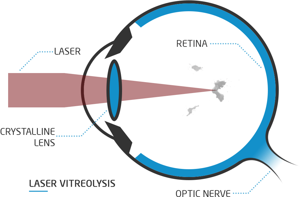 What Is Laser Vitreolysis - Presbiopia Png (1050x750), Png Download