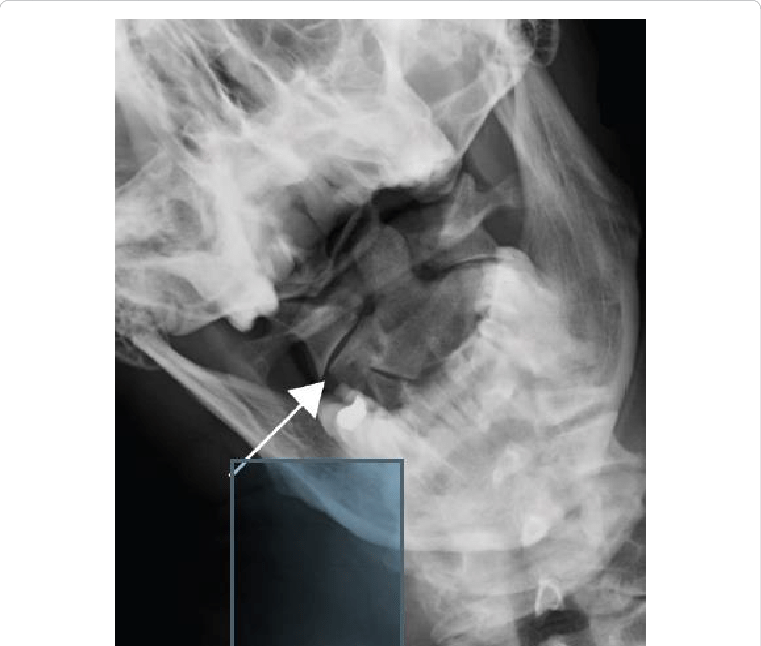 Ap Open Mouth Radiograph Of The C1 C2 Levels Showing - Radiography (761x646), Png Download