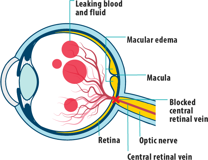 Picture Of Effects Of Mefcrvo On The Eye, Showing Leaking - Macula Of Retina (782x705), Png Download