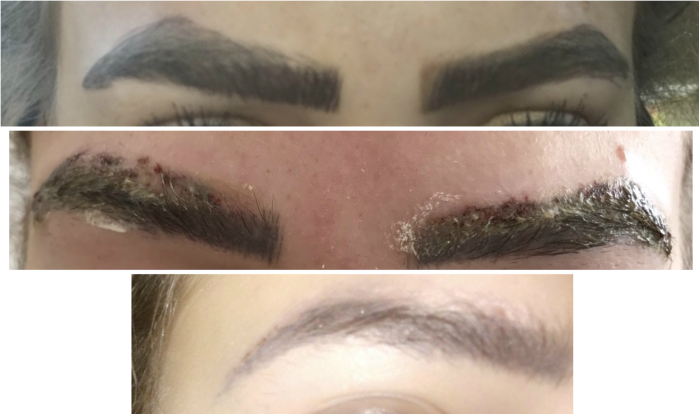 Elinimink Eyebrow Correction - Eyebrow Laser Tattoo Removal (1000x600), Png Download