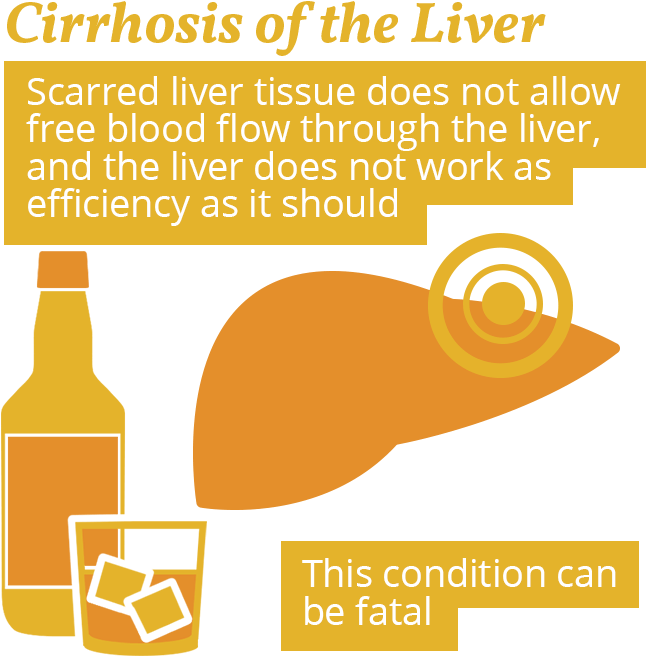 Cirrhosis And Alcohol Use (675x700), Png Download
