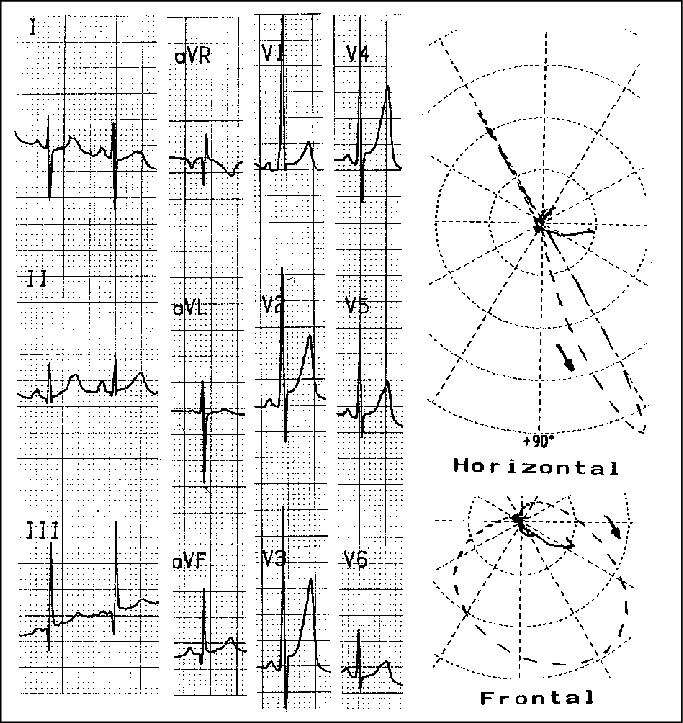 Electro And Vectorcardiogram Revealing Right Ventricular - Diagram (683x723), Png Download