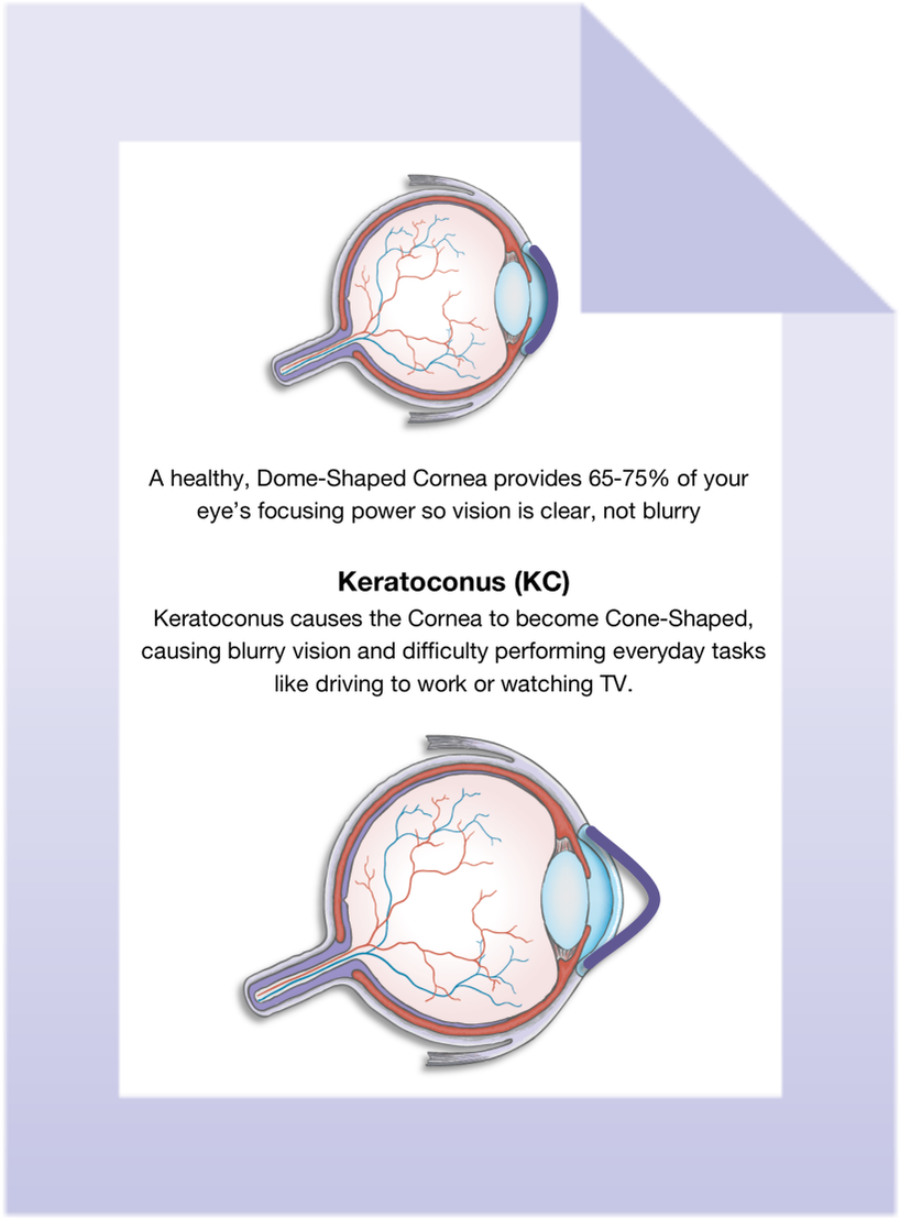 #keratoconus Is An Eye Condition Causing The #cornea - Diagram (1200x1200), Png Download