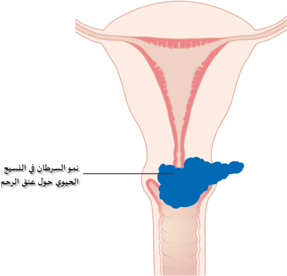 Diagram Showing Stage 2b Cervical Cancer Cruk 216-ar - Cervical Cancer (682x600), Png Download