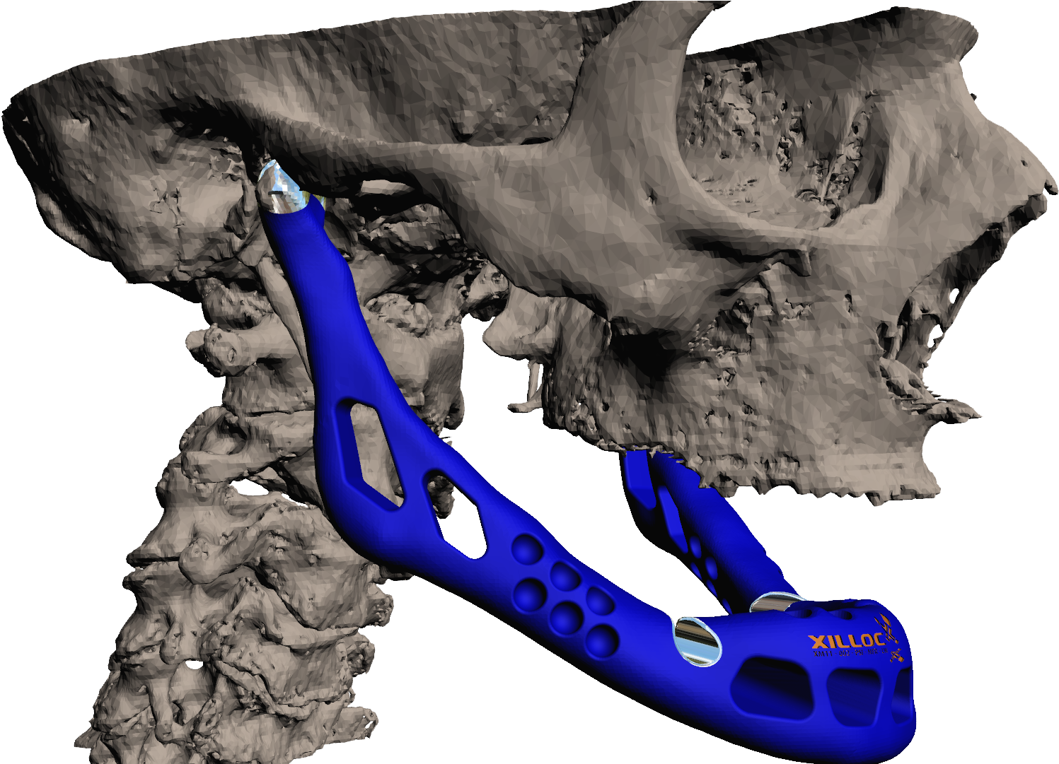 A Lower Jaw Made Of Titanium And Ceramic - Additive Manufacturing In Medical Implants (1920x1080), Png Download