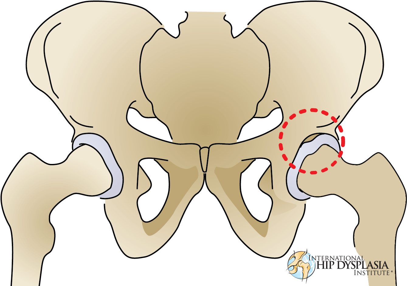 [ ] Enlarge - Hip Dysplasia Torn Labrum (1462x987), Png Download