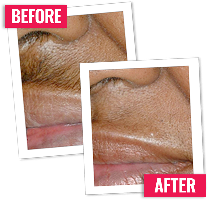 I'm Incredibly Pleased With This Product I Have Two - Beard Removal Cream For Face (694x670), Png Download