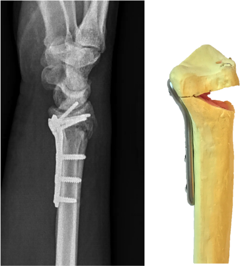 Lateral X-ray Of A Distal Radius Fracture Treated With - Wrist Plate And Screws (893x885), Png Download