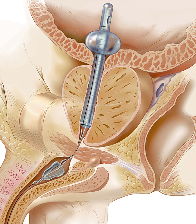 Greatly Preferred By Patients Over Catheterization - Catheter Alternative (754x741), Png Download