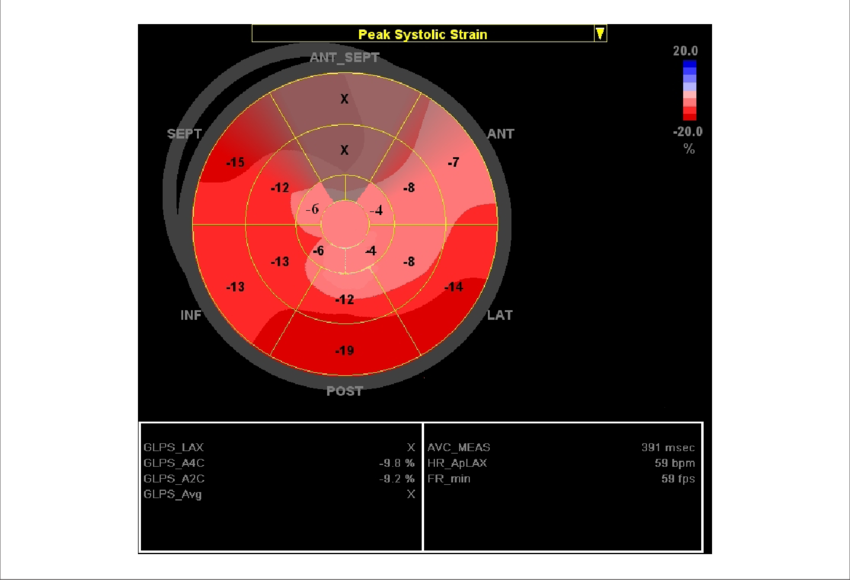 Bull's Eye " View Of The Longitudinal 2d Strain Of - Circle (850x580), Png Download